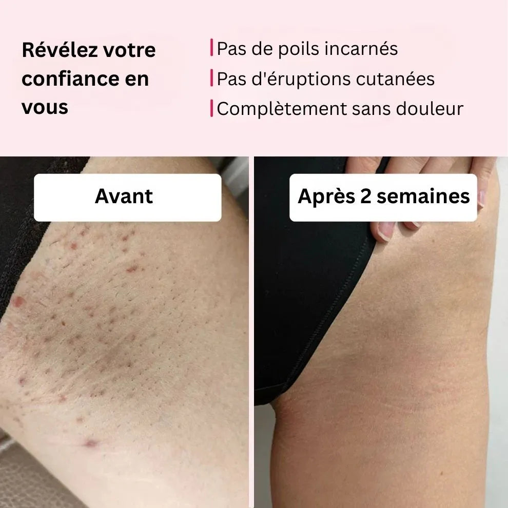 Swifless™ Épilateur IPL - Appareil pour l'élimination des poils